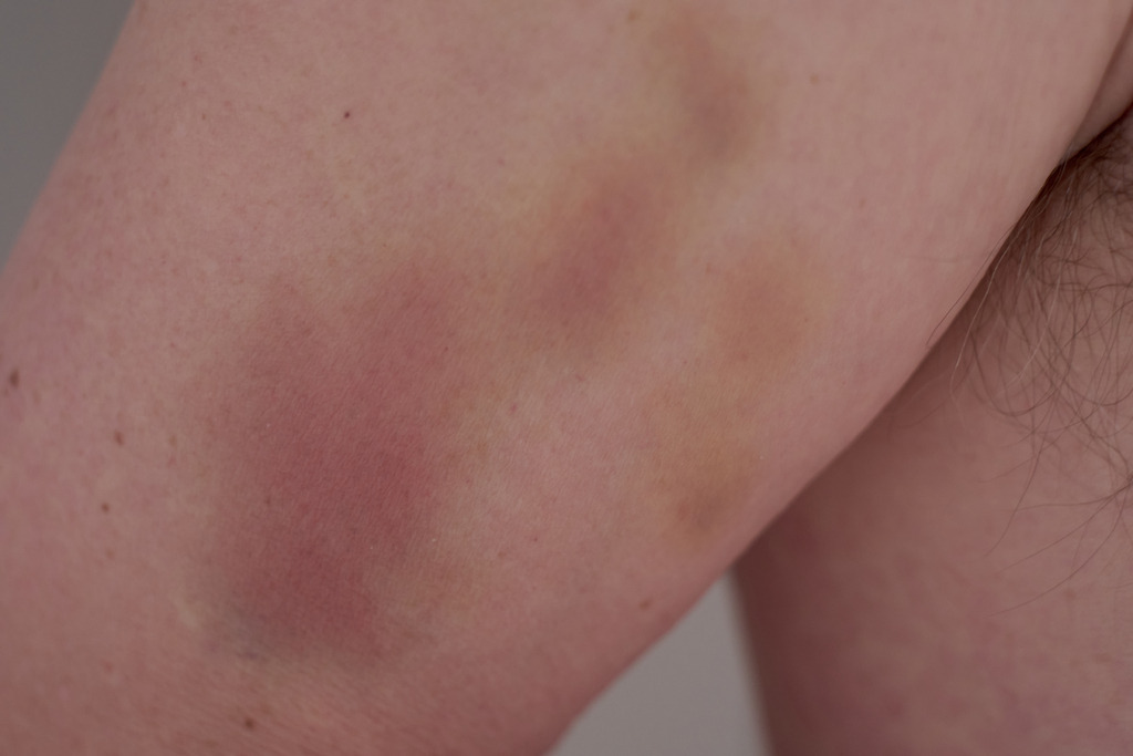 Blaue Flecken auf dem Oberarm | Wien, Austria - May 29, 2025: Blaue Flecken auf dem Oberarm nach einem Kampfsport Training - Realisiert mit Pictrs.com