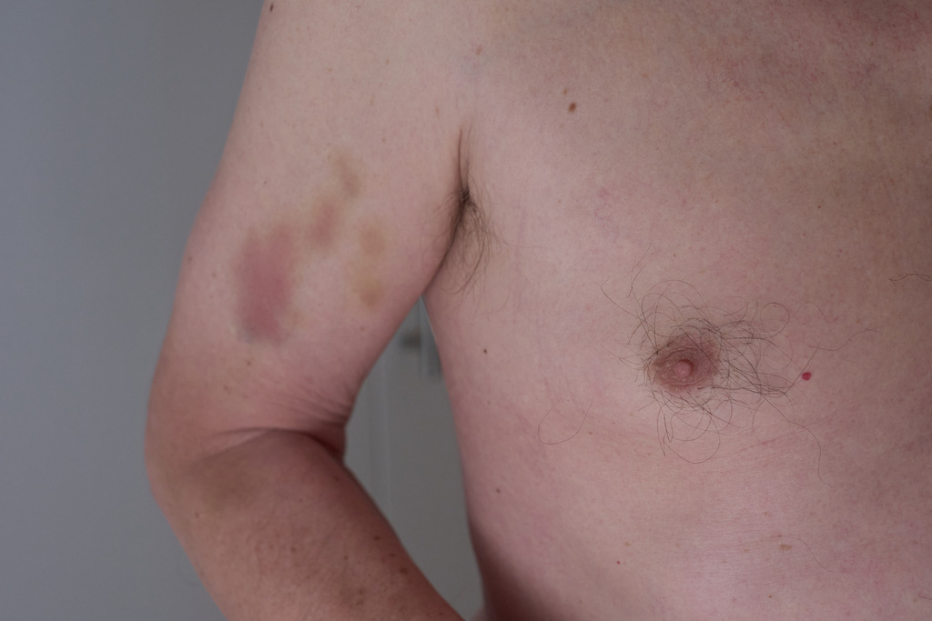 Blaue Flecken auf dem Oberarm | Wien, Austria - May 29, 2025: Blaue Flecken auf dem Oberarm nach einem Kampfsport Training - Realisiert mit Pictrs.com